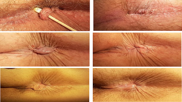  عکس قبل و بعد از عمل بواسیر + بواسیر چیست با عکس