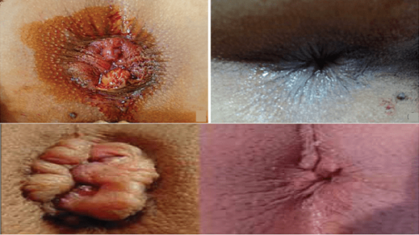  عکس قبل و بعد از عمل بواسیر + بواسیر چیست با عکس