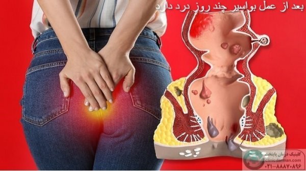  بعد از عمل بواسیر چه بخوریم