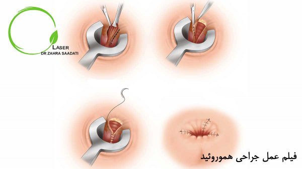  بعد از عمل بواسیر چه بخوریم