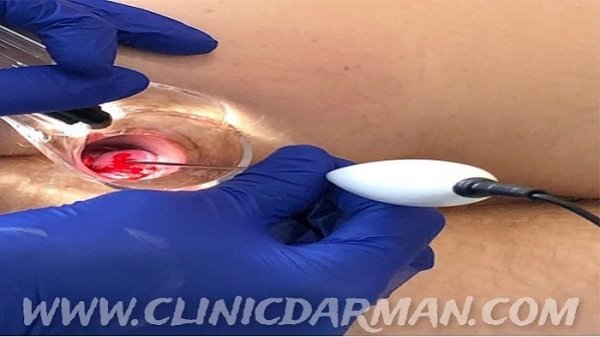  بعد از عمل بواسیر چه بخوریم