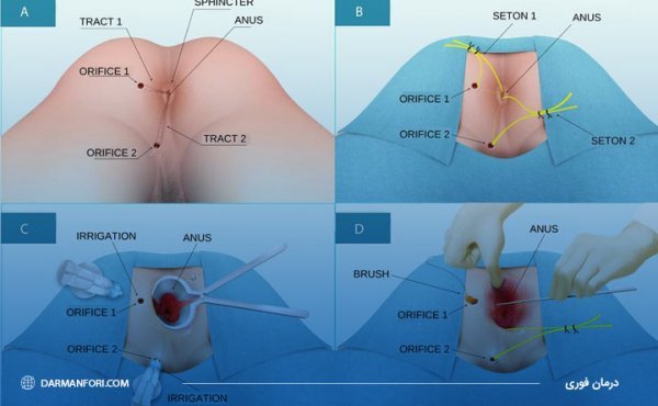  بعد از عمل بواسیر چه بخوریم
