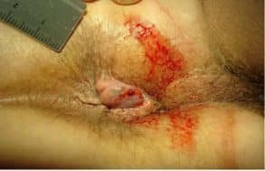  بعد از عمل بواسیر چه بخوریم