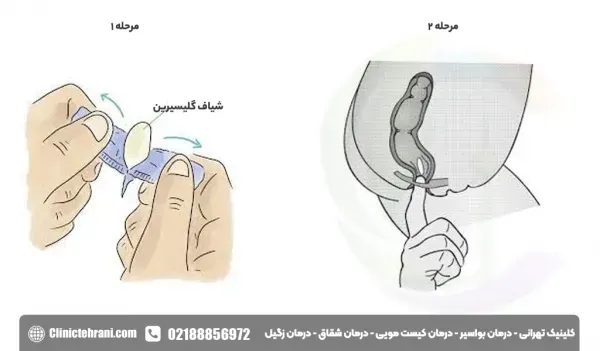 شیاف گلیسیرین بعد از چند دقیقه اثر میکند
