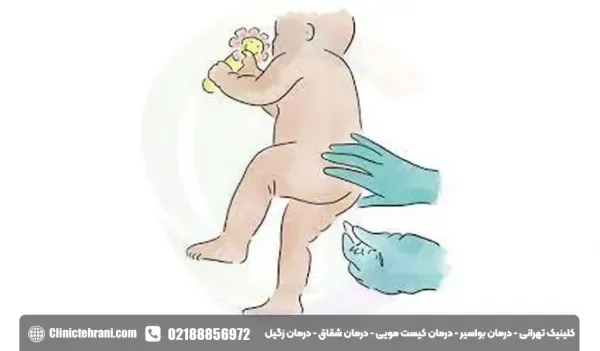  شیاف گلیسیرین بعد از چند دقیقه اثر میکند