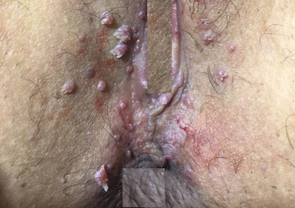  عکس توده سفت زیر پوست در ناحیه تناسلی مرد