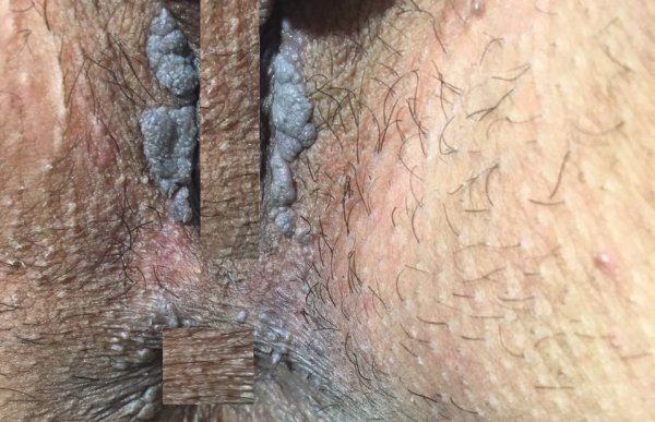  عکس توده سفت زیر پوست در ناحیه تناسلی مرد