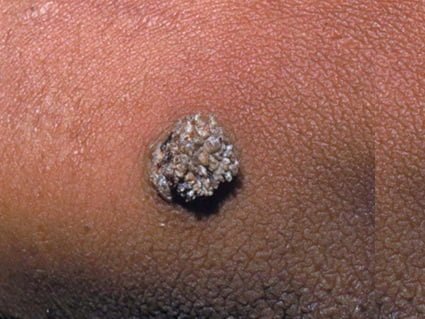  عکس توده سفت زیر پوست در ناحیه تناسلی مرد