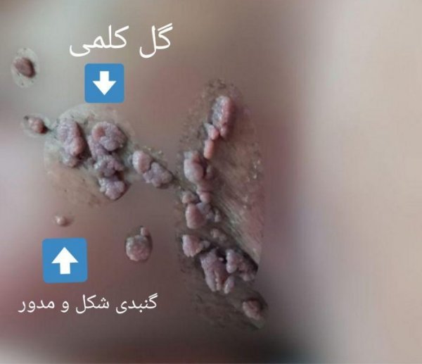  عکس توده سفت زیر پوست در ناحیه تناسلی مرد
