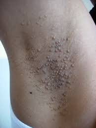  عکس توده سفت زیر پوست در ناحیه تناسلی مرد