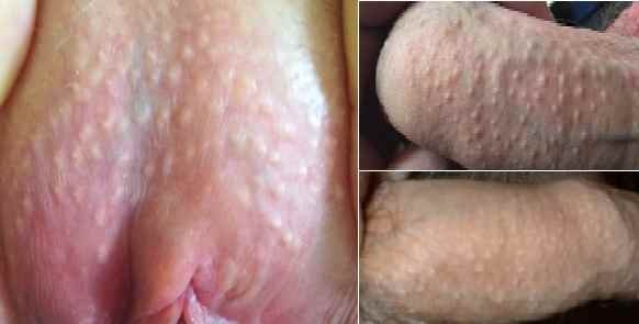  عکس توده سفت زیر پوست در ناحیه تناسلی مرد