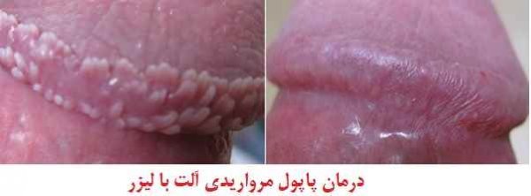  عکس توده سفت زیر پوست در ناحیه تناسلی مرد