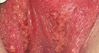  عکس توده سفت زیر پوست در ناحیه تناسلی مرد