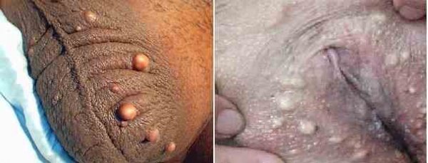  عکس توده سفت زیر پوست در ناحیه تناسلی مرد