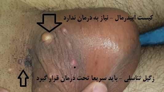  عکس توده سفت زیر پوست در ناحیه تناسلی مرد