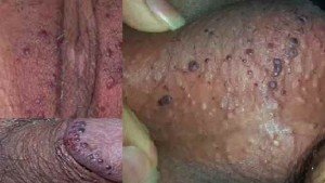  عکس توده سفت زیر پوست در ناحیه تناسلی مرد