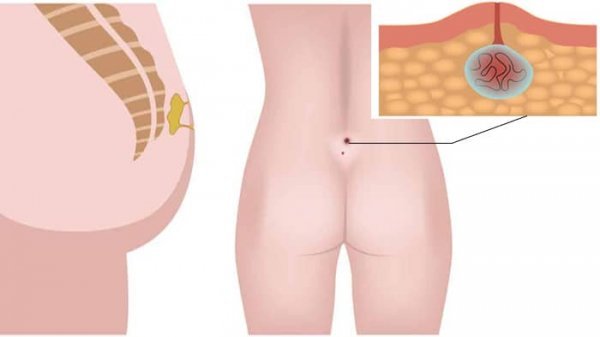  عکس توده سفت زیر پوست در ناحیه تناسلی مرد