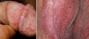  عکس توده سفت زیر پوست در ناحیه تناسلی مرد