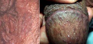  عکس توده سفت زیر پوست در ناحیه تناسلی مرد