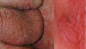  عکس توده سفت زیر پوست در ناحیه تناسلی مرد