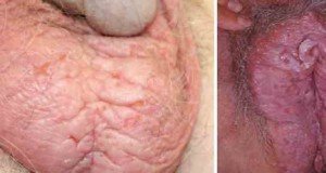  عکس توده سفت زیر پوست در ناحیه تناسلی مرد