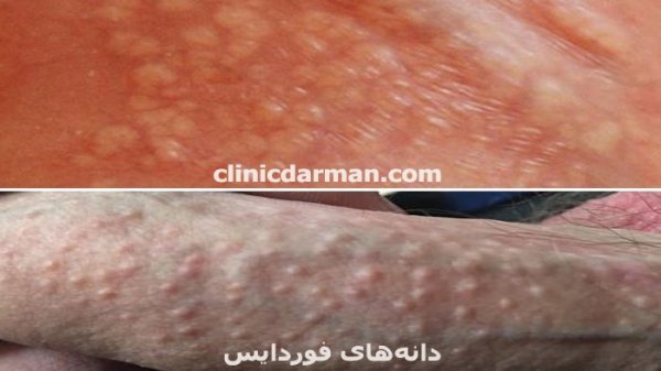  عکس توده سفت زیر پوست در ناحیه تناسلی مرد