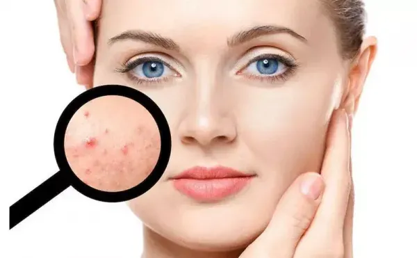  از کجا بفهمیم زگیل تناسلی داریم یا جوش؟؟