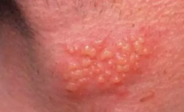  از کجا بفهمیم زگیل تناسلی داریم یا جوش؟؟