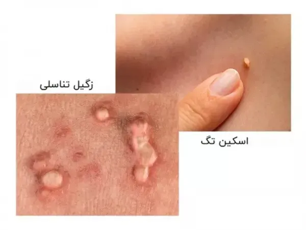  از کجا بفهمیم زگیل تناسلی داریم یا جوش؟؟