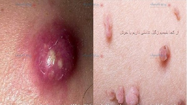  از کجا بفهمیم زگیل تناسلی داریم یا جوش؟؟