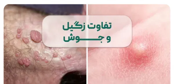  از کجا بفهمیم زگیل تناسلی داریم یا جوش؟؟