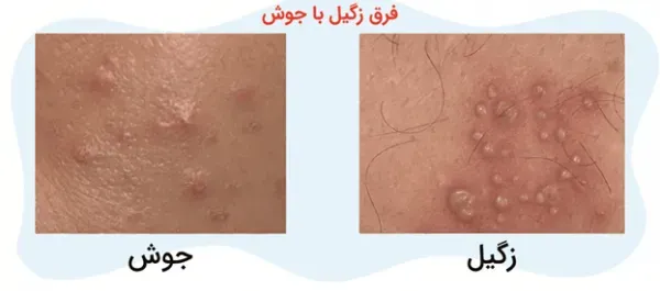  از کجا بفهمیم زگیل تناسلی داریم یا جوش؟؟