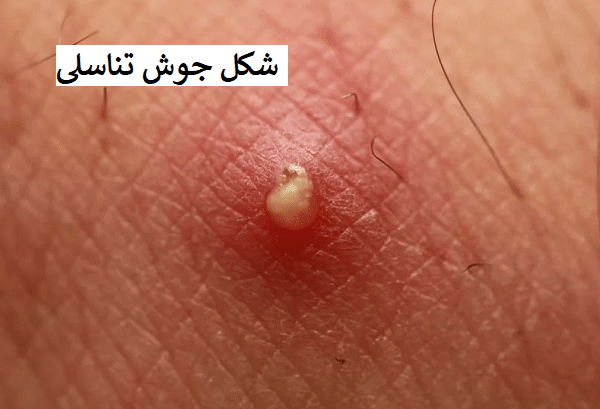  از کجا بفهمیم زگیل تناسلی داریم یا جوش؟؟