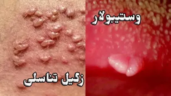  از کجا بفهمیم زگیل تناسلی داریم یا جوش؟؟