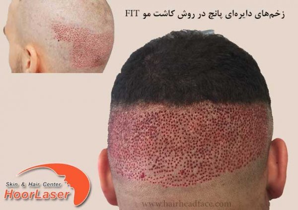  کاشت مو با چه روشی بهتر است