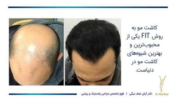  کاشت مو با چه روشی بهتر است