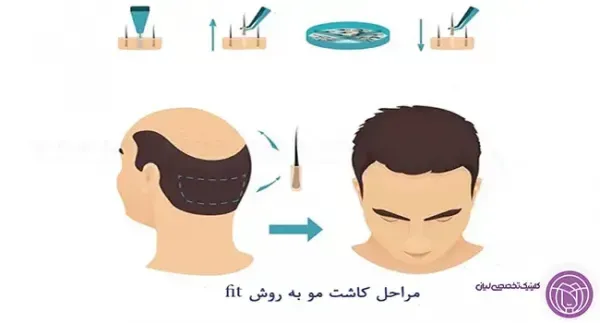  کاشت مو با چه روشی بهتر است