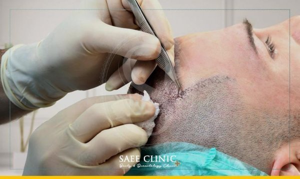  کاشت مو با چه روشی بهتر است