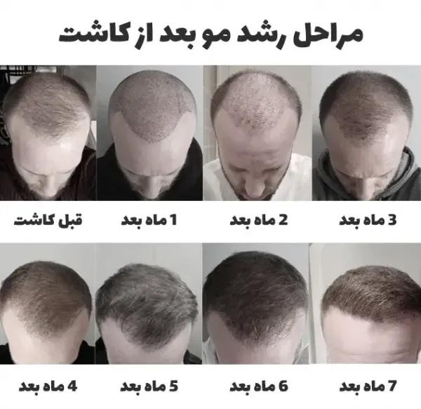  کاشت مو با چه روشی بهتر است