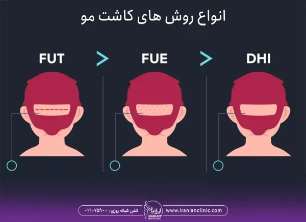 کاشت مو با چه روشی بهتر است