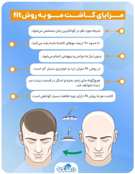  کاشت مو با چه روشی بهتر است