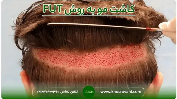  کاشت مو با چه روشی بهتر است