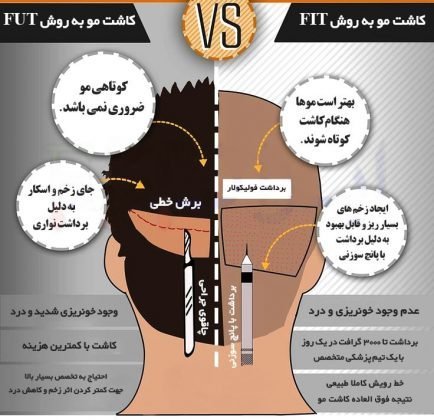  کاشت مو با چه روشی بهتر است