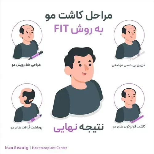  کاشت مو با چه روشی بهتر است