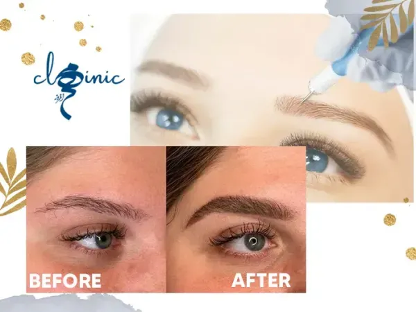  عکس مزوتراپی ابرو + چه مدت بعد از کاشت ابرو باید مزوتراپی کرد