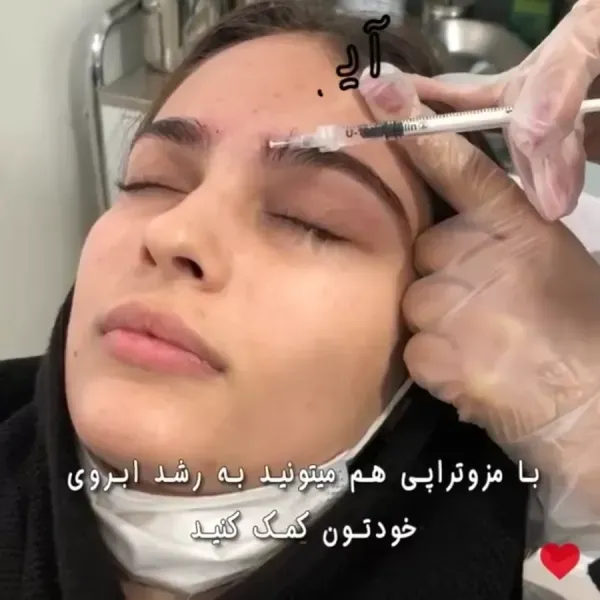  عکس مزوتراپی ابرو + چه مدت بعد از کاشت ابرو باید مزوتراپی کرد