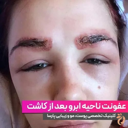  آیا موی سفید را میتوان کاشت