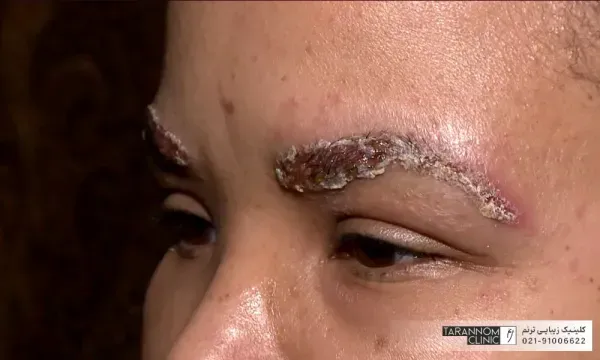  آیا موی سفید را میتوان کاشت