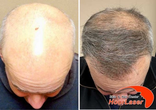  آیا موی سفید را میتوان کاشت