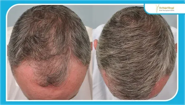  آیا موی سفید را میتوان کاشت